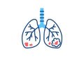 best-lung-cancer-treatment-hospitals-in-hyderabad-small-0