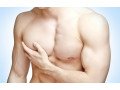 gynecomastia-surgery-in-delhi-india-small-0