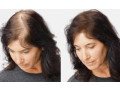 hair-transplant-surgery-in-nashik-small-0