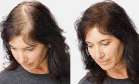 hair-transplant-surgery-in-nashik-big-0