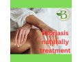 natural-treatments-for-skin-and-scalp-psoriasis-small-0