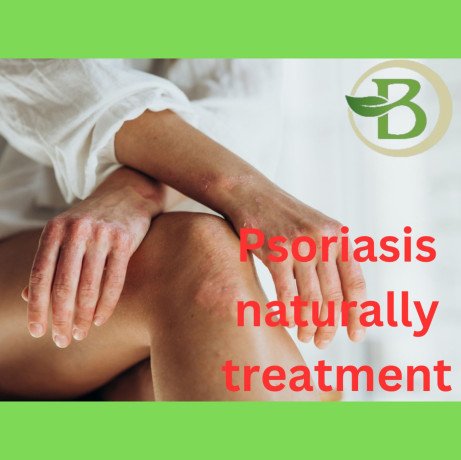 natural-treatments-for-skin-and-scalp-psoriasis-big-0