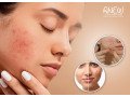 best-acne-laser-treatment-in-bangalore-anew-cosmetic-clinic-small-0