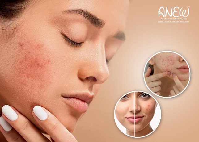 best-acne-laser-treatment-in-bangalore-anew-cosmetic-clinic-big-0