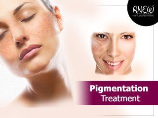 Best Pigmentation Treatment in Bangalore at Anew Cosmetic Clinic