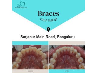 Dental Braces Treatment in Sarjapur Road, Bangalore