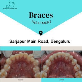 dental-braces-treatment-in-sarjapur-road-bangalore-big-0