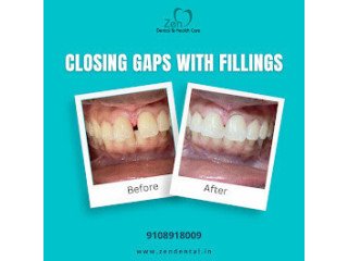 Best Dental Filling Treatment in Sarjapur Road, Bangalore