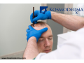 hair-transplants-advanced-hair-loss-solutions-at-kosmoderma-delhi-small-0