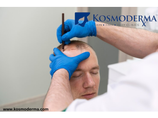 Hair Transplants & Advanced Hair Loss Solutions at Kosmoderma Delhi