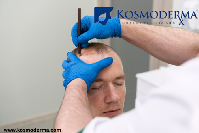 hair-transplants-advanced-hair-loss-solutions-at-kosmoderma-delhi-big-0