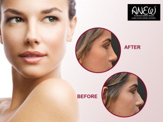 Refine Your Look with Non-Surgical Rhinoplasty in Bangalore