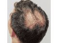 hair-transplant-in-muscat-small-0