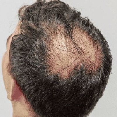 hair-transplant-in-muscat-big-0