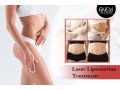 improve-your-body-with-laser-liposuction-at-anew-cosmetic-clinic-small-0