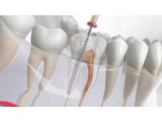 Root Canal Treatment in Karad | Re-RCT in Karad