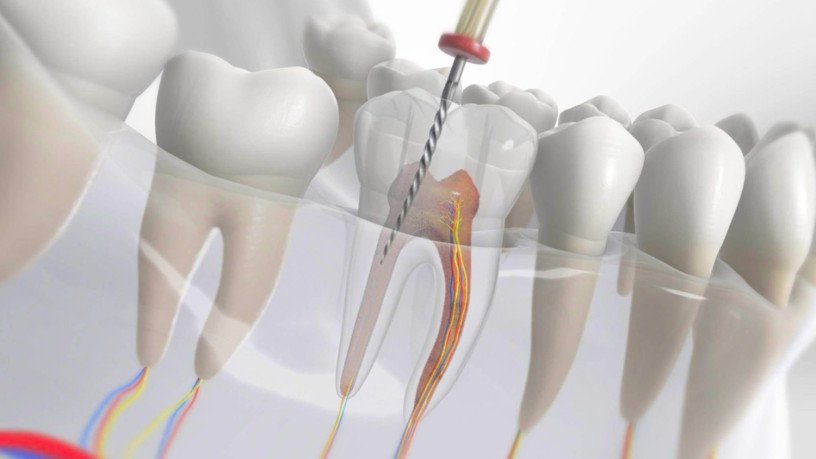 root-canal-treatment-in-karad-re-rct-in-karad-big-0