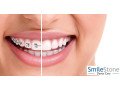 best-dentist-for-implant-dentistry-in-nagpur-small-0