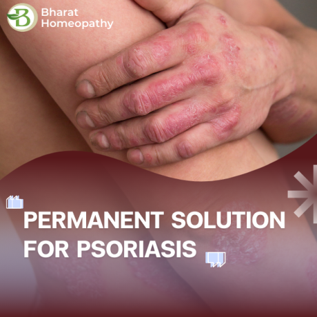 how-to-control-psoriasis-flare-ups-proven-treatment-options-big-0