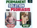 permanent-psoriasis-treatment-is-long-term-relief-possible-small-0