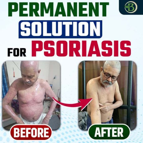 permanent-psoriasis-treatment-is-long-term-relief-possible-big-0