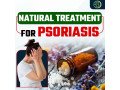 scalp-psoriasis-treatment-explore-the-best-natural-remedies-for-long-term-relief-small-0