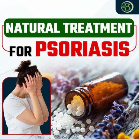 scalp-psoriasis-treatment-explore-the-best-natural-remedies-for-long-term-relief-big-0