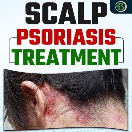 discover-the-best-natural-treatment-for-psoriasis-can-it-be-a-permanent-solution-big-0