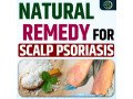 natural-remedy-for-scalp-psoriasis-a-guide-to-permanent-solutions-and-care-small-0