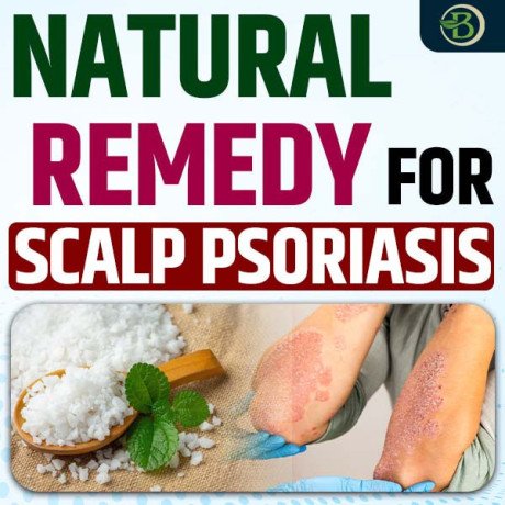 natural-remedy-for-scalp-psoriasis-a-guide-to-permanent-solutions-and-care-big-0