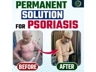 Permanent Solution for Psoriasis: The Best Natural Remedies for Scalp Psoriasis