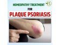 permanent-solution-for-psoriasis-natural-treatments-for-your-skin-small-0