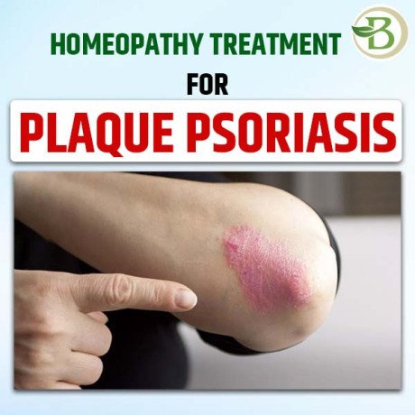 permanent-solution-for-psoriasis-natural-treatments-for-your-skin-big-0