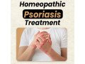 permanent-solution-for-psoriasis-explore-natural-approaches-that-work-small-0