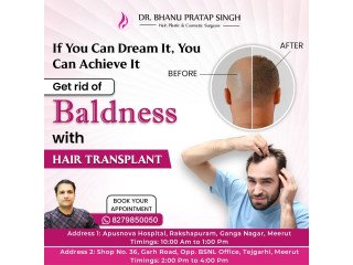 Best Hair Transplant in NCR