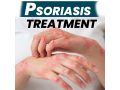 scalp-psoriasis-treatment-explore-the-best-natural-remedies-for-psoriasis-small-0