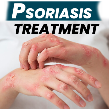 scalp-psoriasis-treatment-explore-the-best-natural-remedies-for-psoriasis-big-0