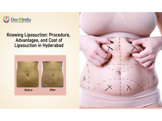 Expert Laser Liposuction in Hyderabad  Transform Your Look Today!