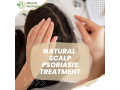 permanent-solution-for-psoriasis-natural-scalp-psoriasis-treatments-small-0