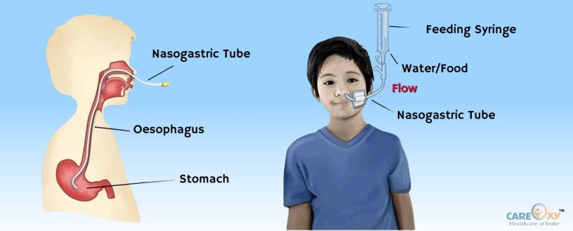 what-is-the-purpose-of-a-nasogastric-tube-big-0