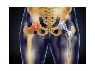 Best Hip Replacement Surgeon In Delhi-Dr. Khera's Wellness Clinic