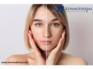 Effective Laser Treatments for Acne Scars and Scar Removal in Delhi