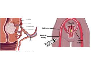 Uterine fibroid treatment in Delhi