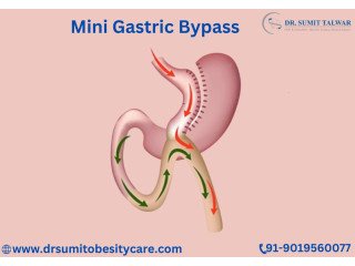 Best Laparoscopic Mini Gastric Bypass Treatment in Bangalore