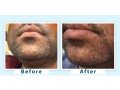 top-dermatologists-in-delhi-for-effective-grey-beard-treatment-small-0