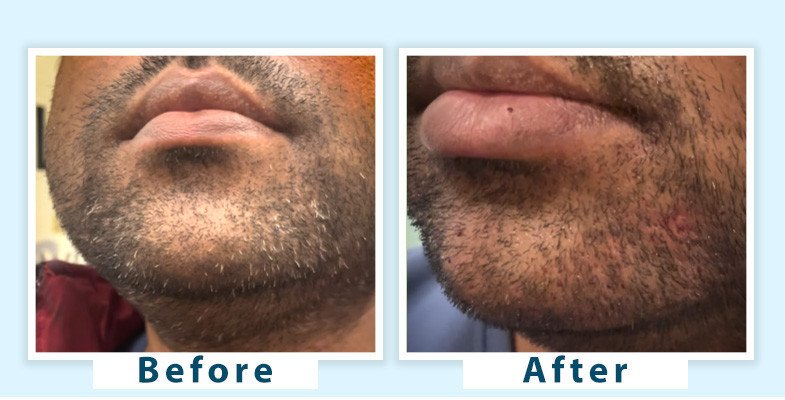 top-dermatologists-in-delhi-for-effective-grey-beard-treatment-big-0