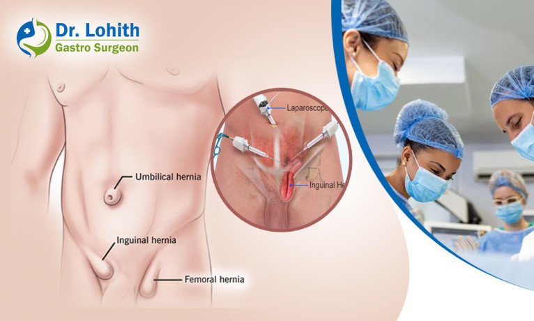 best-hernia-surgery-in-bangalore-dr-lohith-u-big-0