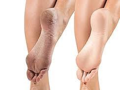 best-foot-roll-on-for-cracked-heels-natural-relief-from-river-of-herbs