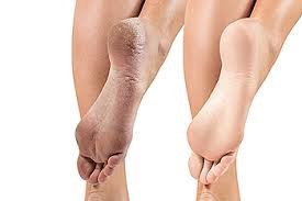 best-foot-roll-on-for-cracked-heels-natural-relief-from-river-of-herbs-big-0