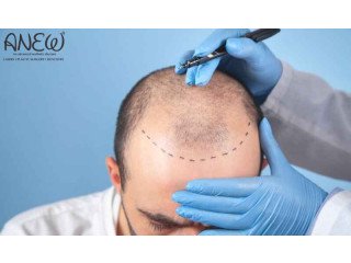 Best Hair Transplant in Bangalore - Anew Cosmetic Clinic